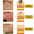 [PAGUE 1, LLEVA 2] TAG RECEDE - REMOVEDOR DE VERRUGAS