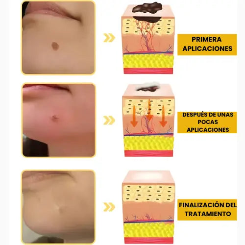 [PAGUE 1, LLEVA 2] TAG RECEDE - REMOVEDOR DE VERRUGAS